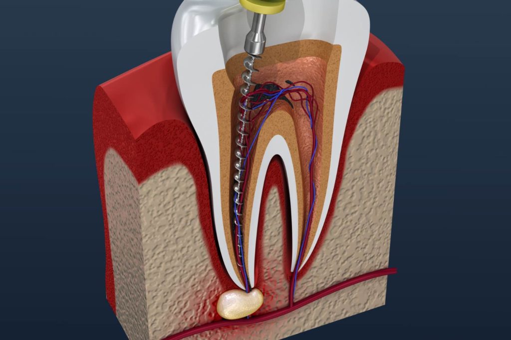 signs of root canal