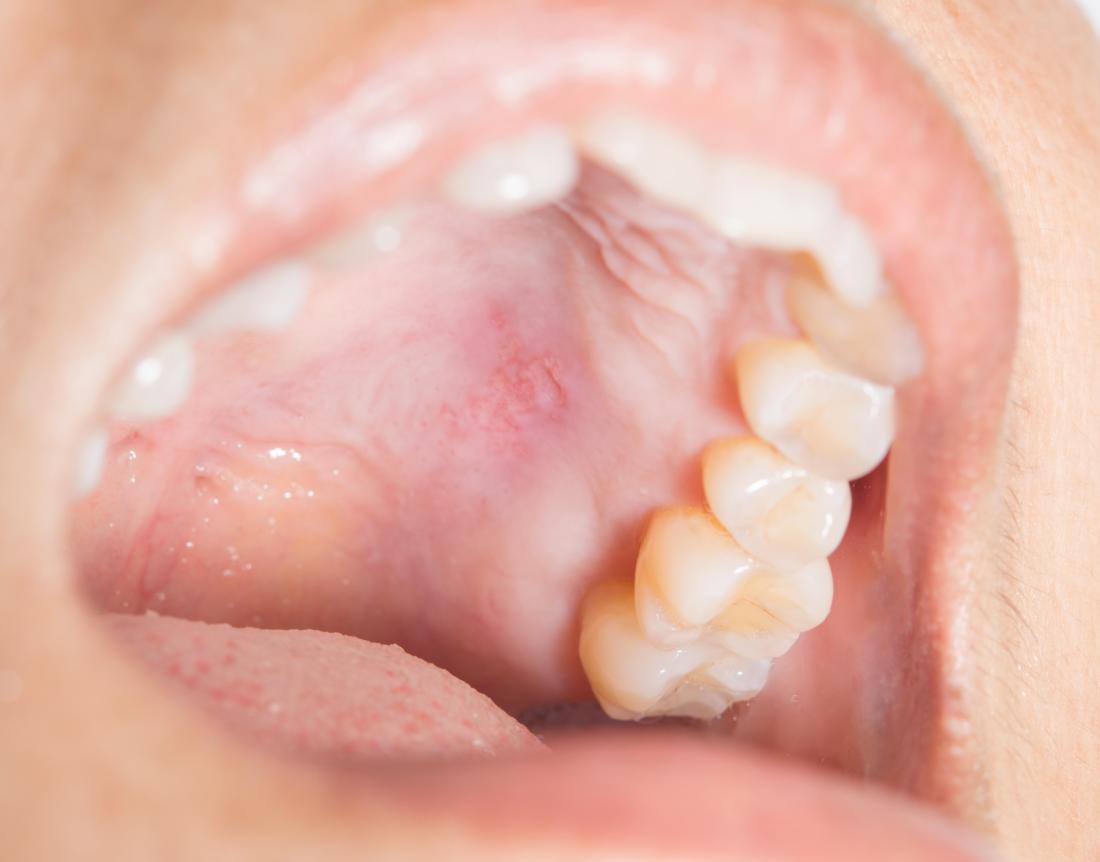 abscess on roof of mouth